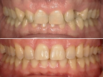 caso ortodoncia adultos pamplona 02