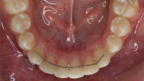 despues tratamiento ortodoncia arcos deprit