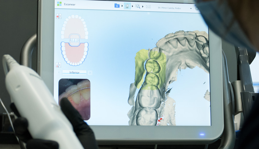 escaner ortodoncia invisible zaragoza
