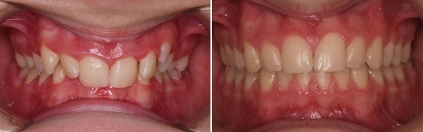 ortodoncia convencional60 1