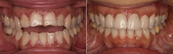 ortodoncia implantes estetica 1