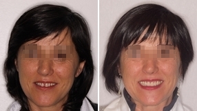 ortodoncia implantes estetica